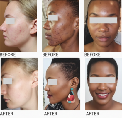Anti-Acne Range – Complete Skincare Set for Clear, Balanced Skin